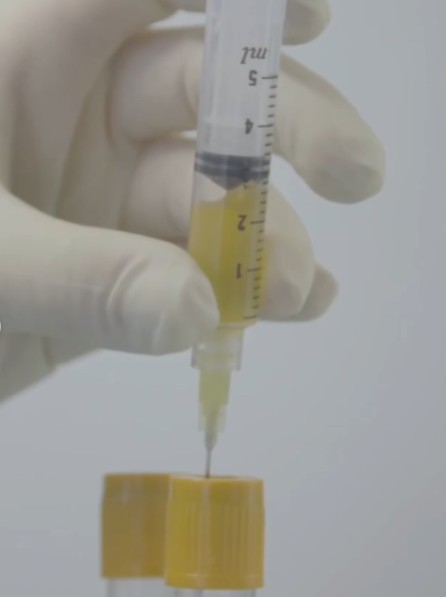 En que consiste el PRP (plasma rico en plaquetas)
