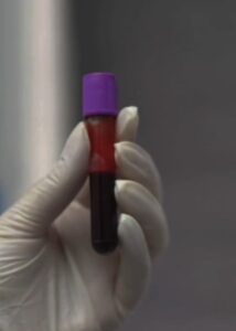 PRP (plasma rico en plaquetas) En que consiste el PRP (plasma rico en plaquetas)