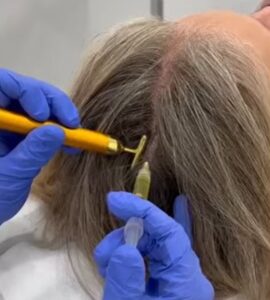 PRP (plasma rico en plaquetas) En que consiste el PRP (plasma rico en plaquetas)