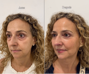 Antes/después de utilizar la técnica ID Fresh Look