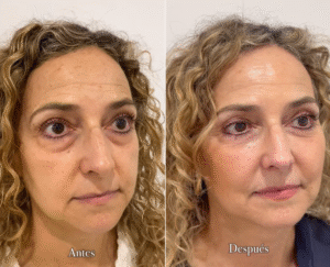 Antes/después de utilizar la técnica ID Fresh Look