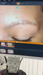 Repoblamiento de cejas: los mejores tratamientos disponibles