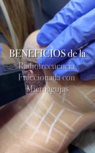 Radiofrecuencia fraccionada con microagujas