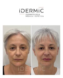 Rejuvenecimiento facial full face: Tratamiento integral sin cirugía para armonizar el rostro