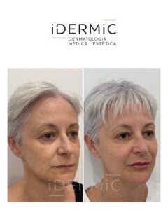 Rejuvenecimiento facial full face: Tratamiento integral sin cirugía para armonizar el rostro
