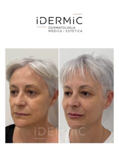 Rejuvenecimiento facial full face: Tratamiento integral sin cirugía para armonizar el rostro