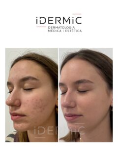 Programa ClearSkin de Idermic Programa ClearSkin de Idermic. Imagen lateral