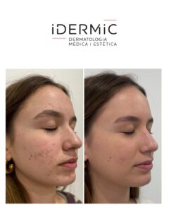 Programa ClearSkin de Idermic Programa ClearSkin de Idermic. Imagen lateral