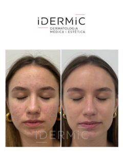 Programa ClearSkin Programa ClearSkin de Idermic. Imagen Frontal