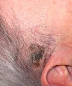 Cáncer de piel Diagnóstico y tratamiento del cáncer de piel