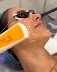 Tratamiento con láser IPL + FRAX