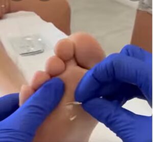 Las verrugas víricas y su tratamiento con crioterapia e inmunoterapia.
