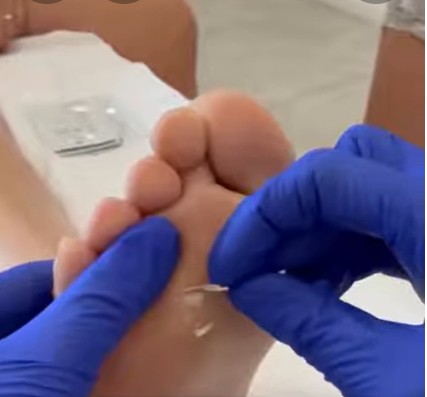 Las verrugas víricas y su tratamiento con crioterapia e inmunoterapia.