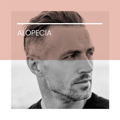 Alopecia. Dermatología Clínica en Idermic.