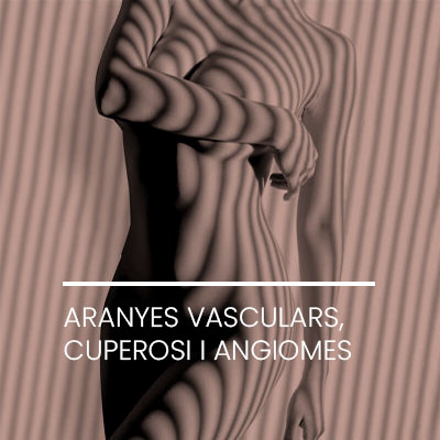 Láser Aranyes vascular cuperosi angiomes. Clinica Idermic