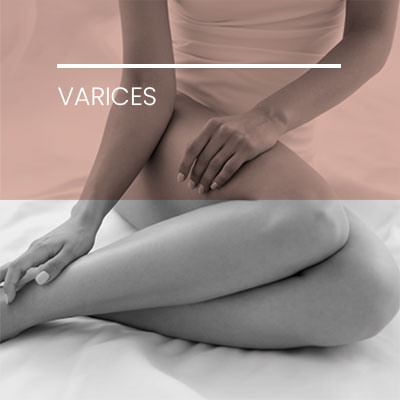 Tratamiento de varices con láser. Clínica Idermic