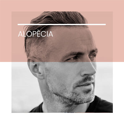 Alopecia. Clínica Idermic