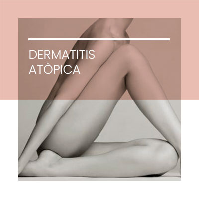 Dermatitis atopica. Clínica Idermic