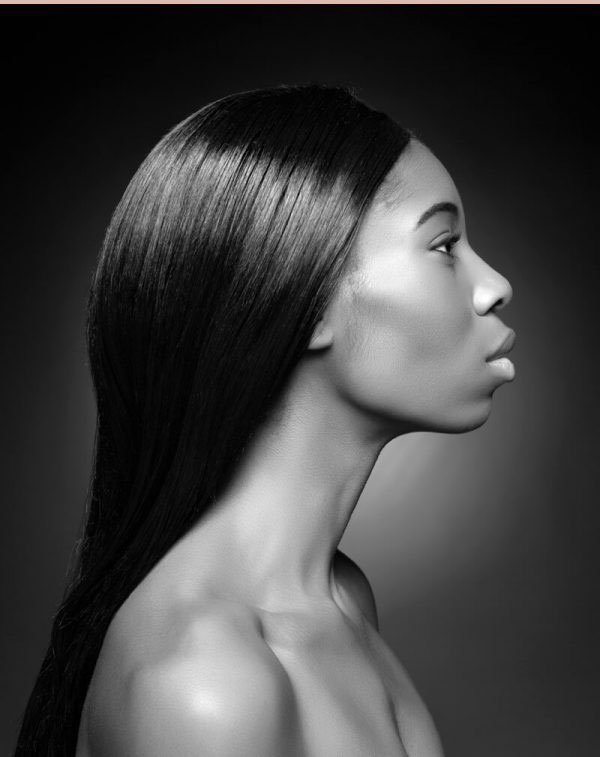Dermatología estética. Aumento de pómulos. Clínica Idermic
