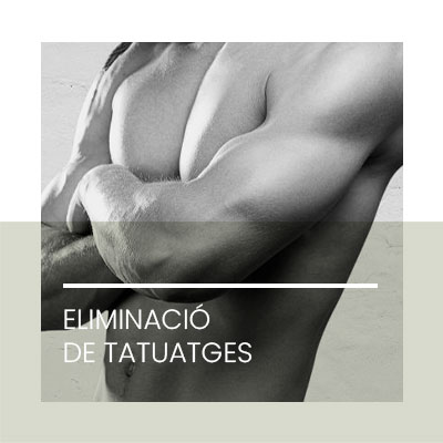 Láser Eliminacio tatuatges. Clinica Idermic