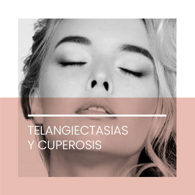 Telangiectasias y cuperosis. Clínica Idermic