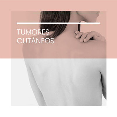 Tumores cutáneos. Dermatología Clínica en Idermic.