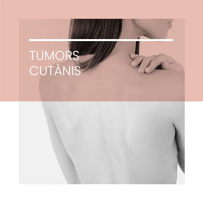 Tumors cutanis. Clínica Idermic