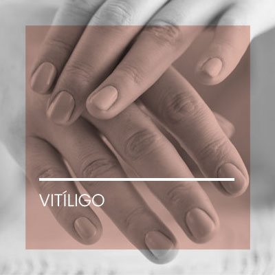 Vitiligo. Dermatología Clínica en Idermic.