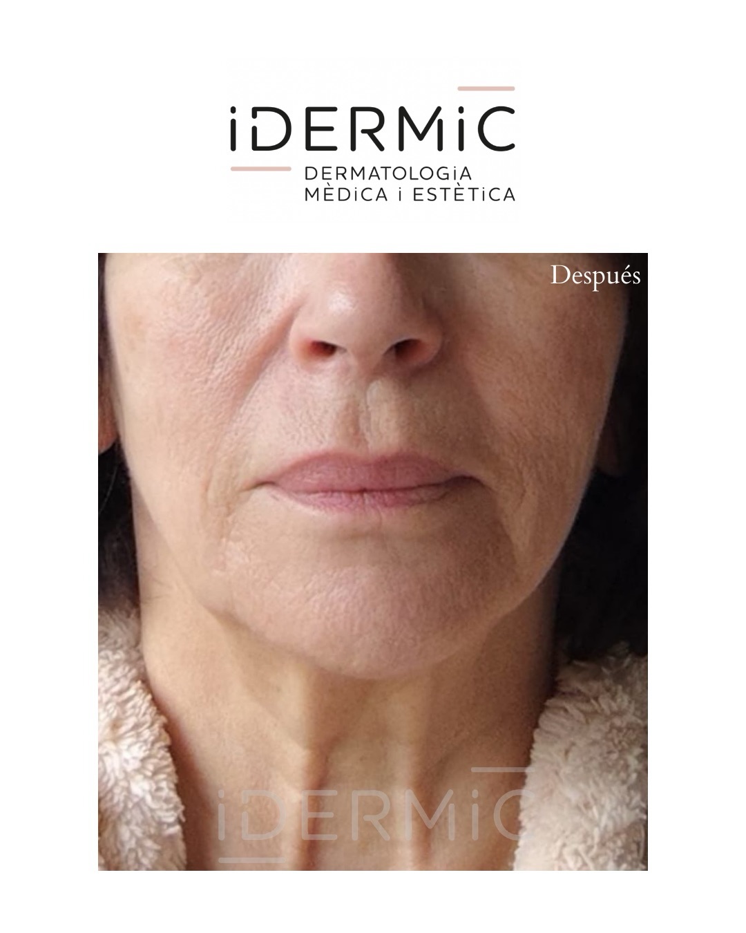 Tratamiento de óvalo facial y cuello con HIFU Liftera