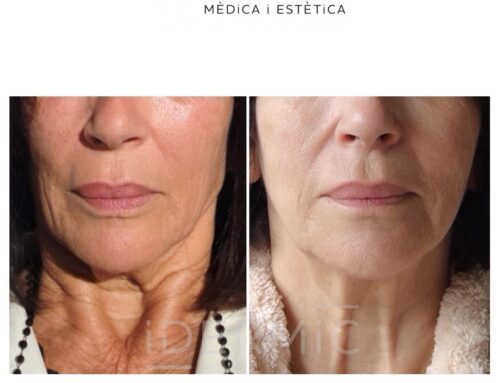 Óvalo facial y cuello: Mejores tratamientos según la flacidez, la papada y la pérdida de definición