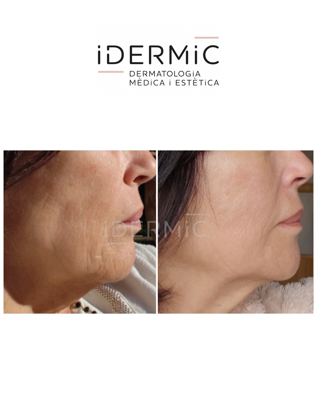 Antes/después de la utilización de HIFU Liftera en óvalo facial y cuello.