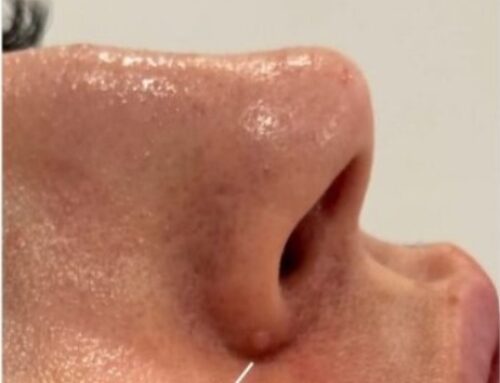 Pàpula fibrosa nasal: eliminació amb làser de plasma