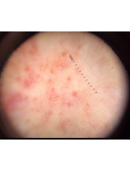 Imatge ampliada d’aquesta afecció dermatològica. Foto 2