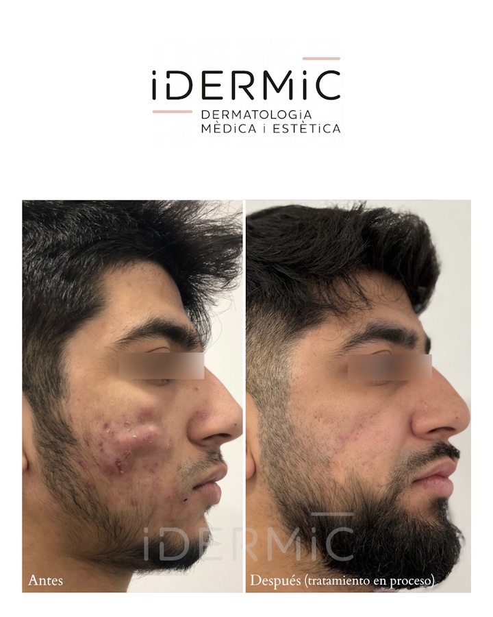 Tratamiento del acné noduloquístico. Antes y después-1