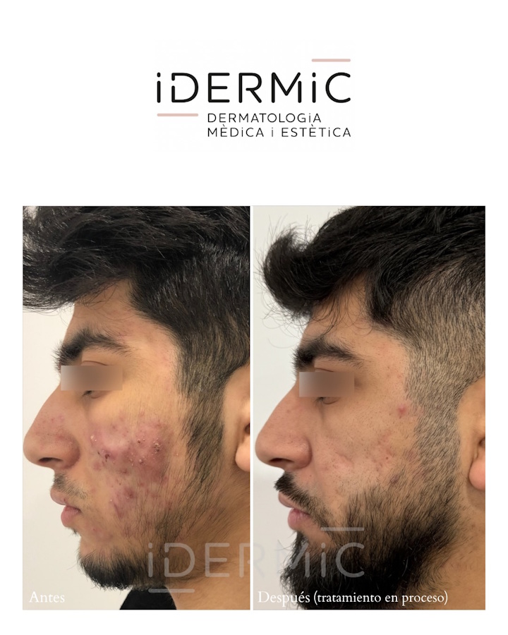 Tratamiento del acné noduloquístico. Antes y después-2