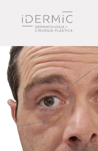 Eliminació de xantelasmes: tractament sense cicatrius