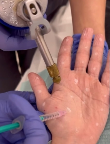 Hipersudoració palmar: neuromodulació eficaç i segura