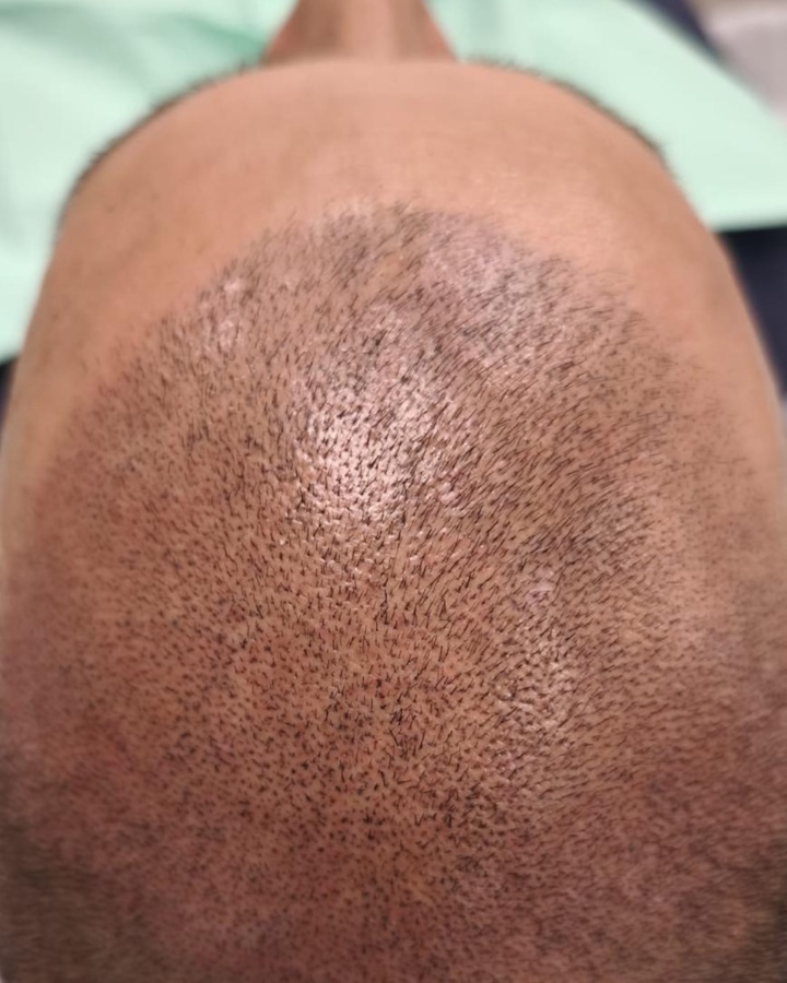 Micropigmentación Médica y Estética-1 Tratamientos de Micropigmentación Médica y Estética Clínica Idermic de Terrassa. Relleno capilar