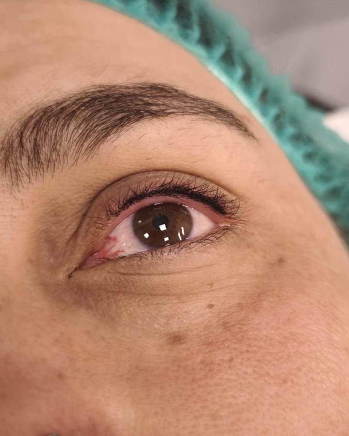 Micropigmentación Médica y Estética Tratamientos de Micropigmentación Médica y Estética Clínica Idermic de Terrassa. Diseño de cejas pelo a pelo-2