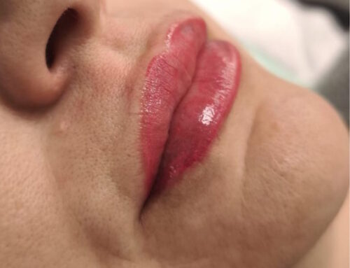 Micropigmentación Médica y Estética: nuevo servicio especializado en Idermic