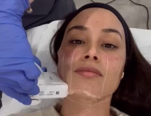 HIFU facial amb Liftera. Lífting facial no invasiu i eficaç