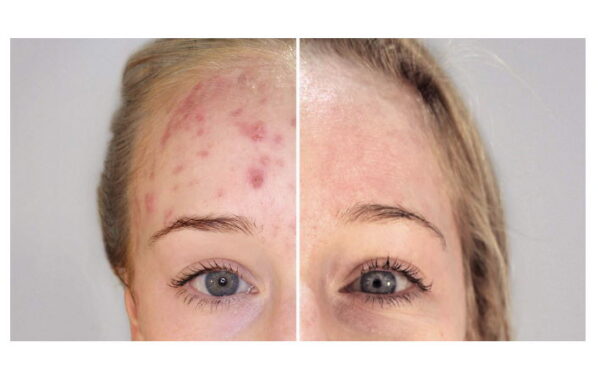KLERESCA® ACNE TREATMENT