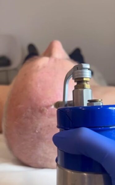 Queratosis actíniques
